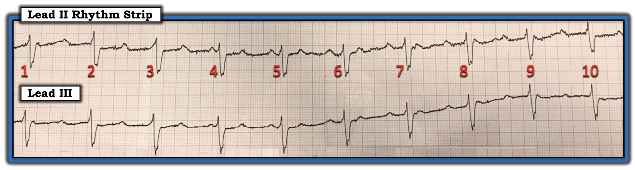 ECG Review Figure Oct. 15, 2022 IM