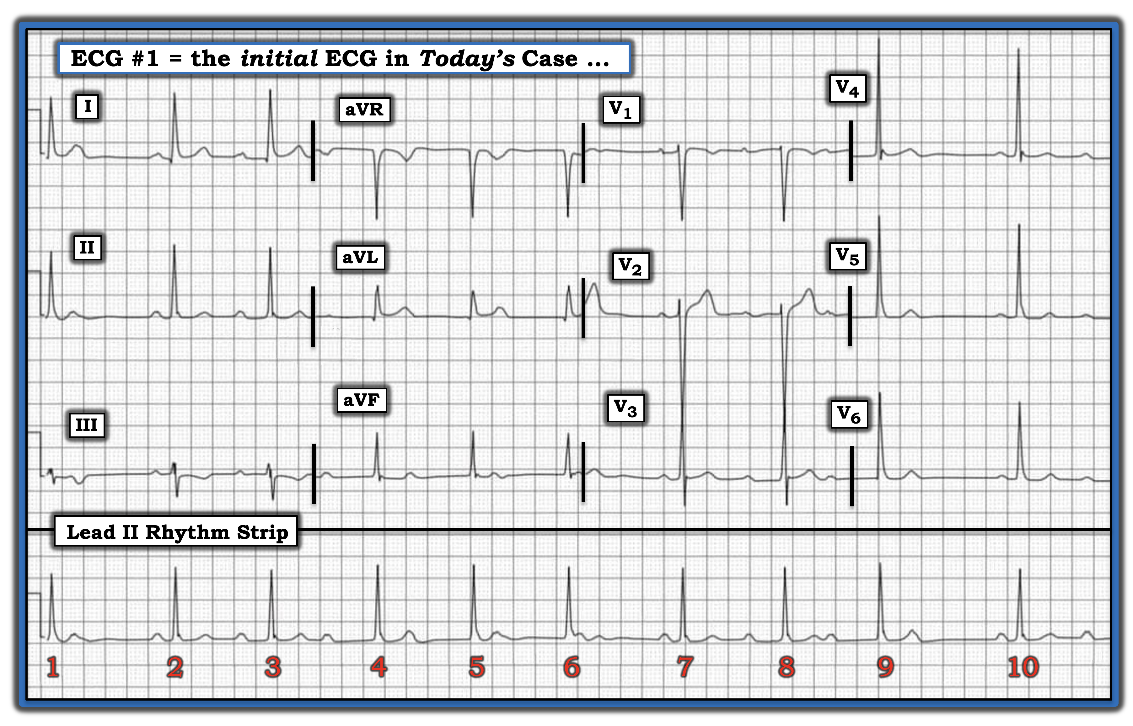 ECG Review Figure January 15, 2023