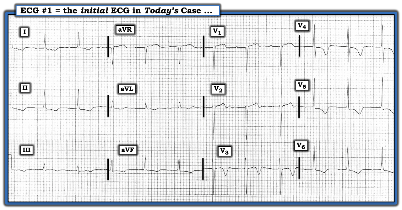 ECG Review Figure June 15 2023 IM