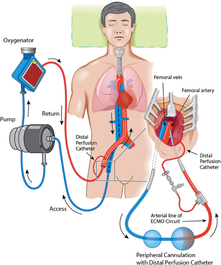 Cardiopulmonary resuscitation - Wikipedia