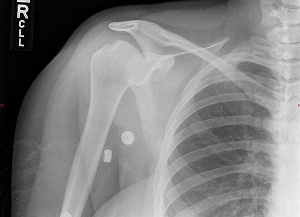 Shoulder Trauma (Fractures and Dislocations) - OrthoInfo - AAOS