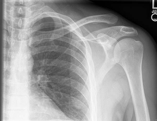 Shoulder Trauma (Fractures and Dislocations) - OrthoInfo - AAOS