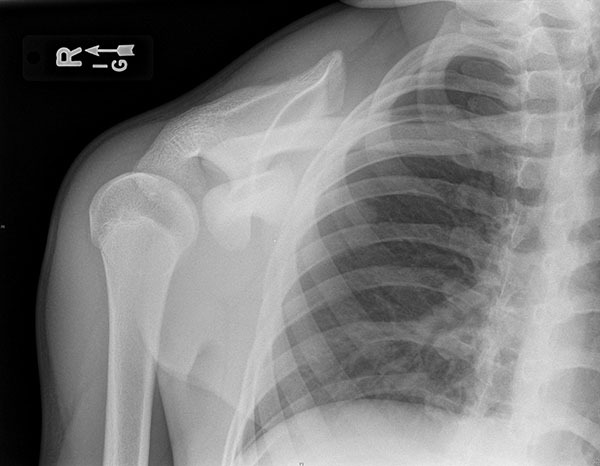 Shoulder Trauma (Fractures and Dislocations) - OrthoInfo - AAOS