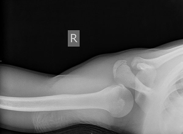 Elbow Dislocation - OrthoInfo - AAOS