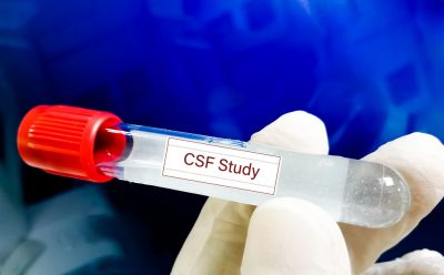 Test tube with CSF Getty Images 1387473382