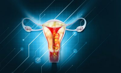 Endometrial cancer Getty Images 1453756098