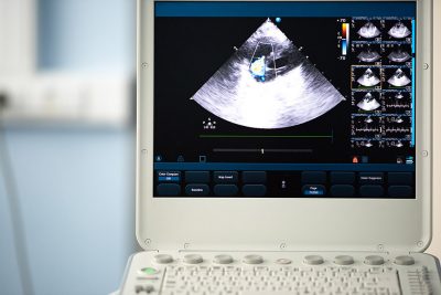 Aortic regurgitation Getty Images 1000784120