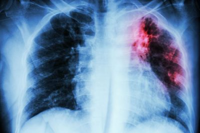 Tuberculosis Getty Images 468719560