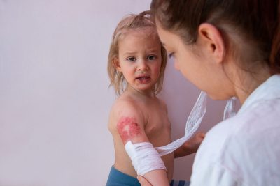 Pediatric burn Getty Images 1824231544