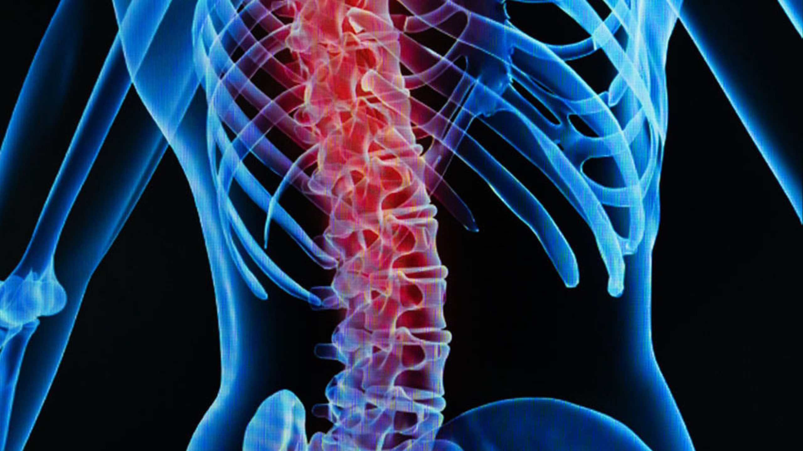 Spinal Cord Compression Clinician com