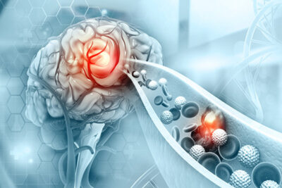 Statin Stroke