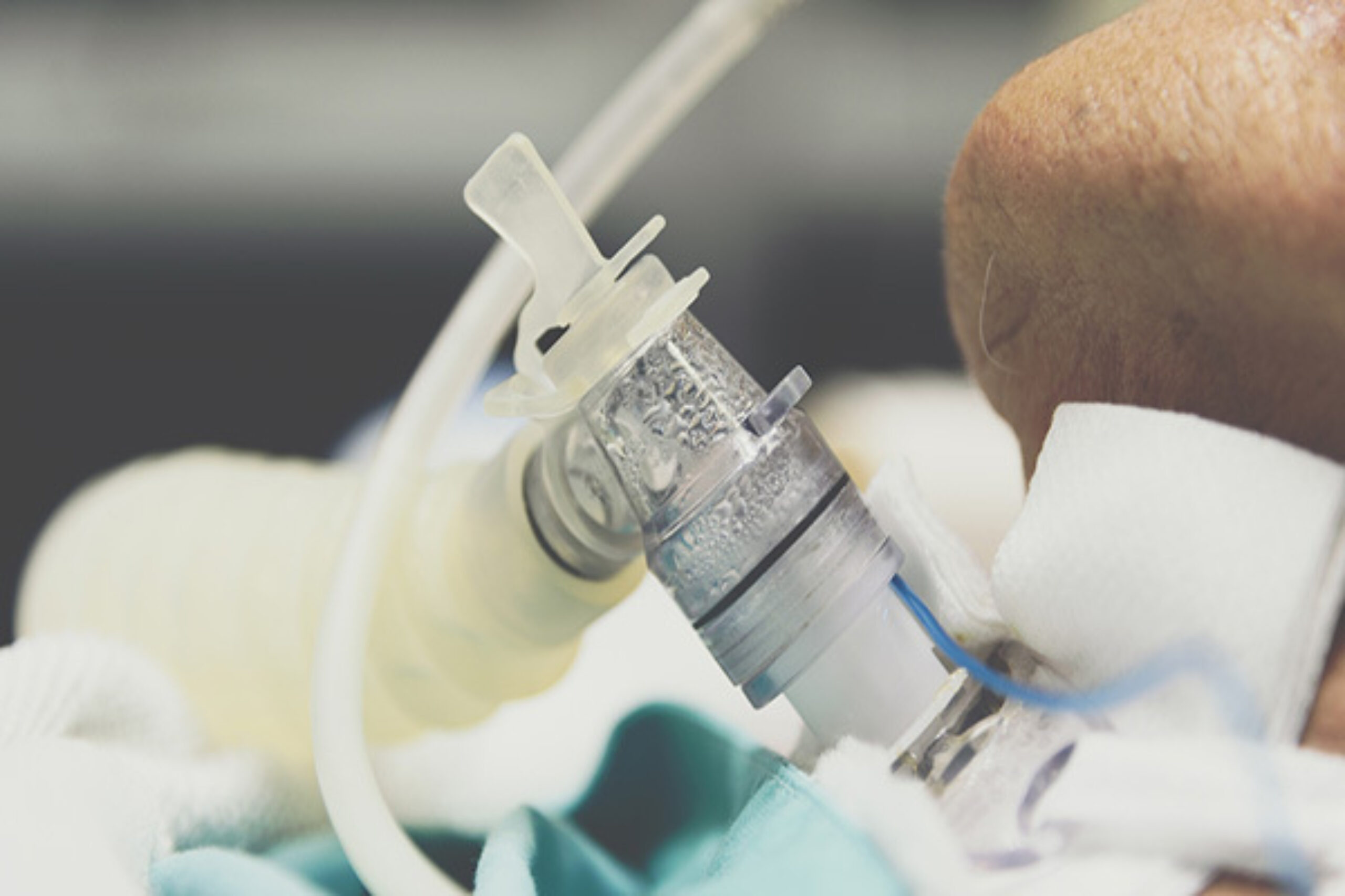 Novel Bedside Procedure Improves Tracheostomy Outcomes | Relias Media