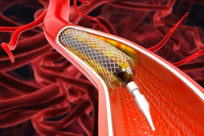 Stent illustration Getty Images 1483219481