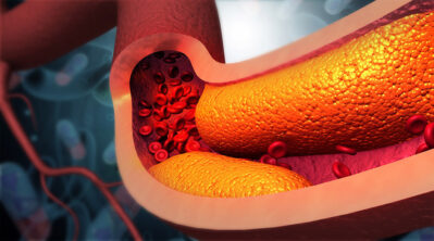 Atherosclerosis illustration Getty Images 1500794663