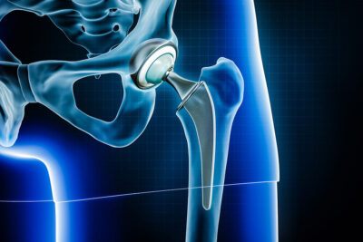 Joint replacement illustration Getty Images 1439770371