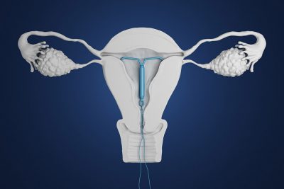 IUD placement illustration Getty Images 940414888