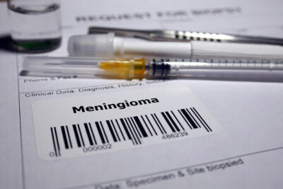 Meningioma biopsy order Getty Images 1128842992