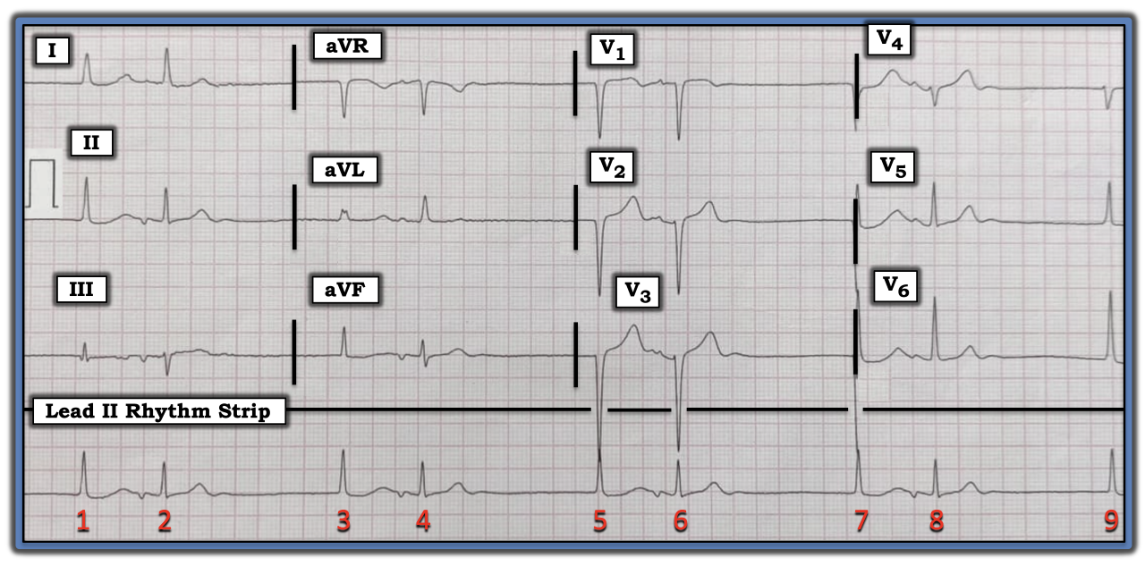 IMA 111522 ECG Review