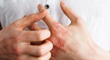 Talem Atopic Dermatitis article image